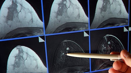 Mit einem Mammographie-Screening kann Brustkrebs zeitig entdeckt werden. (Symbolbild) / Foto: Jan-Peter Kasper/dpa-Zentralbild/dpa