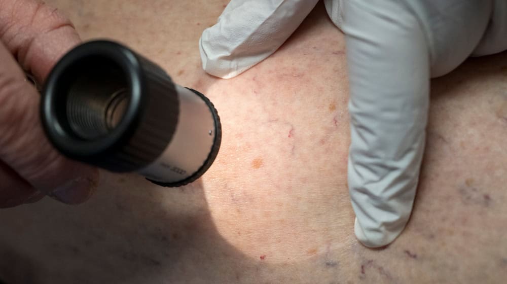 Hautkrebsfälle steigen nach Krankenkassen-Zahlen in Niedersachsen deutlich an. (Symbolbild) / Foto: Peter Kneffel/dpa