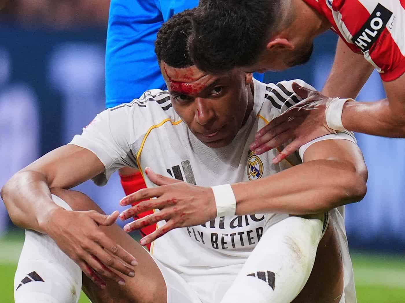 Mbappé wurde im Spiel gegen Girona im Gesicht getroffen. / Foto: Manu Fernandez/AP/dpa