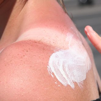 Damit es hinterher keine Schäden gibt: Wer draußen ist, sollte sich vor der Sonne schützen. (Symbolfoto) / Foto: Stephanie Pilick/dpa/dpa-tmn