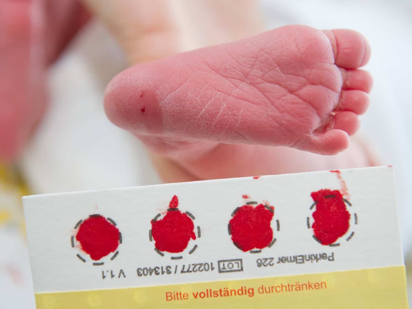 Neugeborenen-Screening: 281 Kinder in Bayern mit Mukoviszidose entdeckt