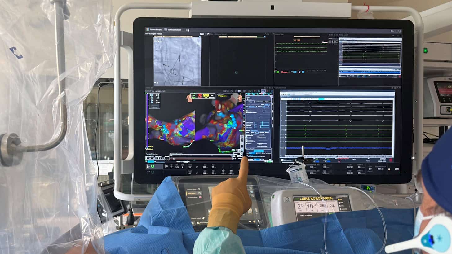 Katheterablation, die Vorhofflimmern verhindern soll.