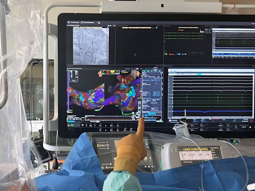 Katheterablation, die Vorhofflimmern verhindern soll.