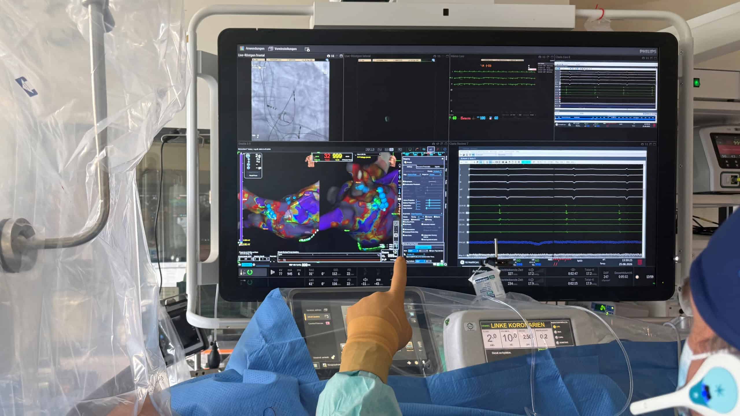 Katheterablation, die Vorhofflimmern verhindern soll.