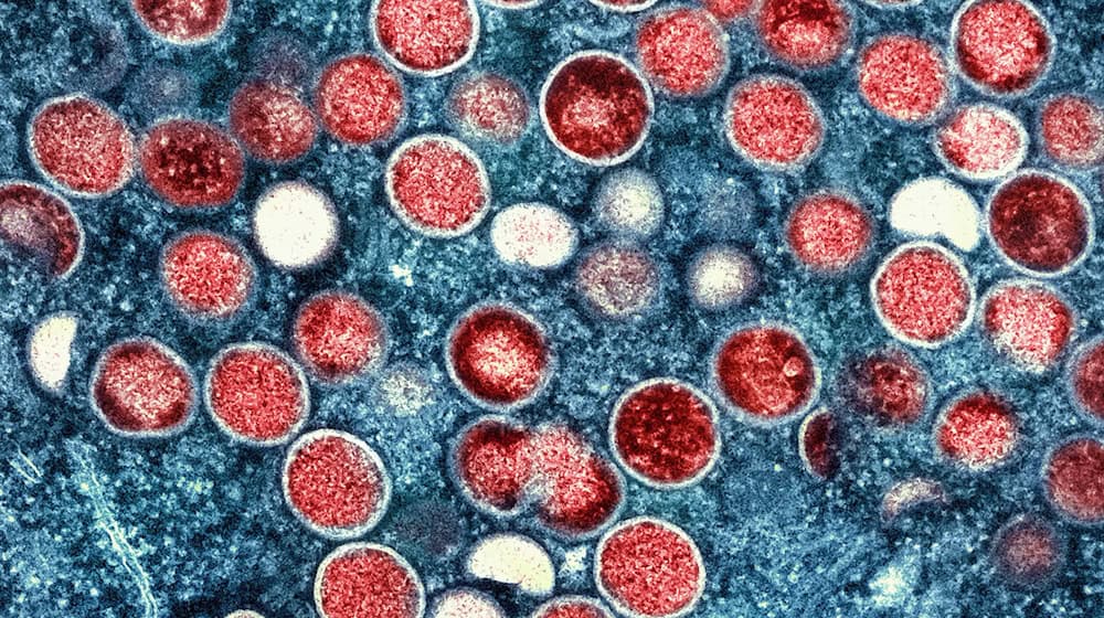 Eingefärbte Mikroskopaufnahme von Mpox-Partikeln: Im Vergleich zum Jahr 2022 befinden sich die Fallzahlen in Deutschland auf niedrigem Niveau. (Symbolbild) / Foto: National Institute of Allergy and Infectious Diseases/AP/dpa