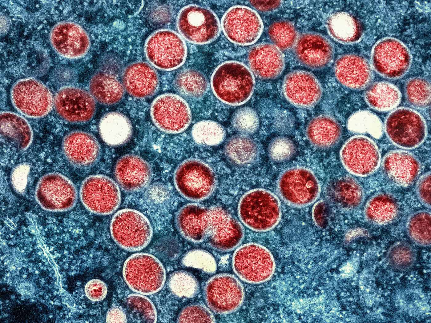 Das Virus löst vor allem Hautausschlag aus, aber auch Fieber und Muskelschmerzen. (Symbolbild) / Foto: -/National Institute of Allergy and Infectious Diseases/dpa