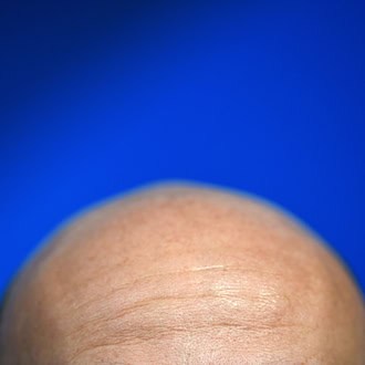 Glatze und selbstbewusst, diese Message möchte der Berliner Adrien Bocquier vermitteln. (Symbolbild) / Foto: picture alliance / dpa