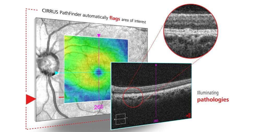 ZEISS: CE-Kennzeichnung für CIRRUS PathFinder für KI-unterstützte OCT-Auswertung erhalten