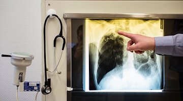 Ein Arzt zeigt einen Tuberkulose-Fall anhand eines Röntgenbildes. / Foto: Gregor Fischer/dpa