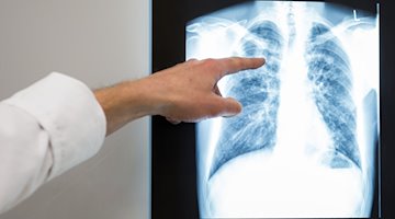 Ein Arzt zeigt im Vivantes Klinikum Neukölln auf das Röntgenbild einer Lunge. / Foto: Silas Stein/dpa