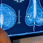 Medizinisches Personal untersucht mit einer Mammografie die Brust einer Frau auf Brustkrebs. / Foto: Hannibal Hanschke/dpa