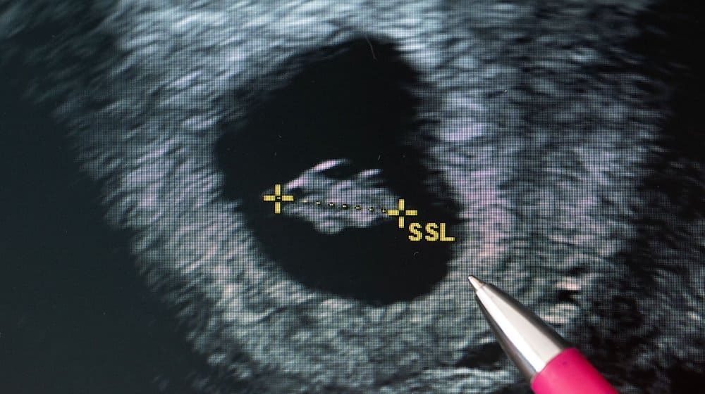 Eine Frauenärztin deutet auf den Fötus im Ultraschallbild. / Foto: Hendrik Schmidt/dpa
