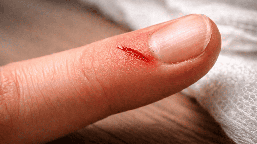 Even minor injuries can become infected and, in the worst case, lead to sepsis. Leipzig researchers want to improve the treatment of blood poisoning. © AI-generated with ChatGPT