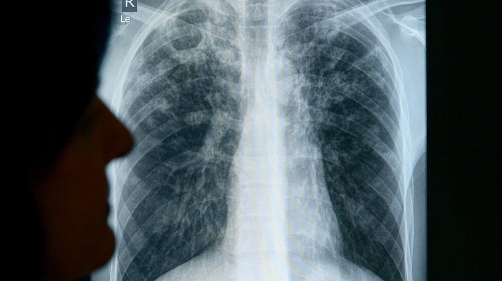 Another case of tuberculosis has been detected in the district of Bautzen. (Symbolic image) / Photo: Rainer Jensen/dpa