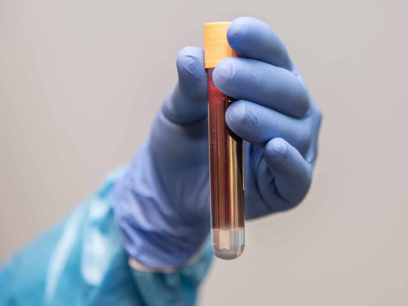 Eine Blutprobe zeigt, ob die Krankheit zurückgedrängt ist. Mit der neuen Dresdner Therapie gelingt das fast doppelt so vielen Patienten wie bisher.