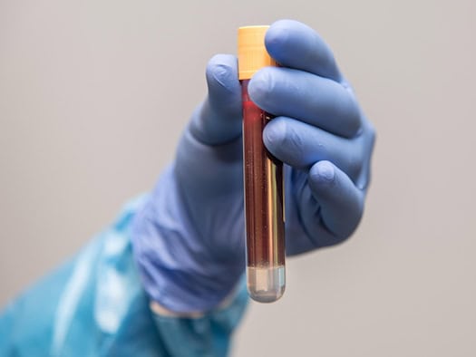 A blood test shows whether the disease has been suppressed. With the new Dresden therapy, almost twice as many patients succeed as before.