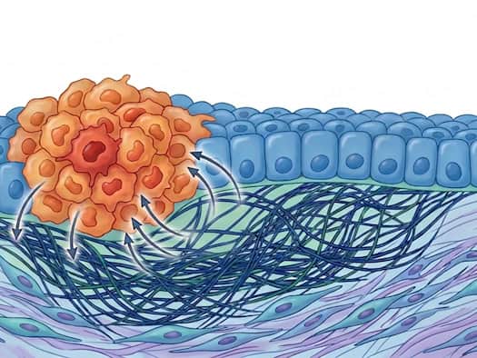 It is not only genes that determine whether a tumor grows: connective tissue and fibroblasts play an active role from the very beginning.