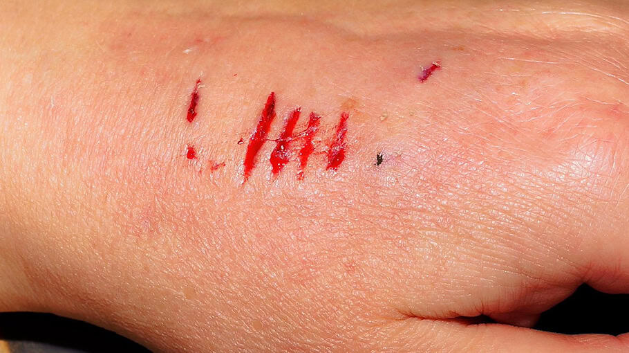 Mann in Oderwitz am Oberen Viebig von Hund gebissen