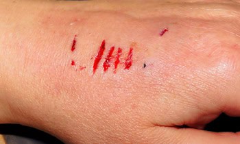 Mann in Oderwitz am Oberen Viebig von Hund gebissen